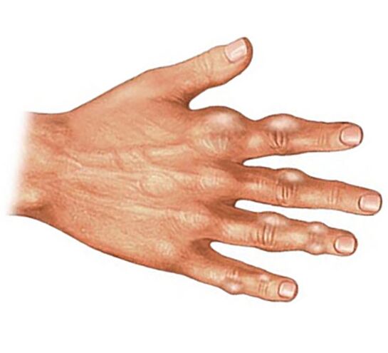 Deposit of uric acid crystals in the soft tissues of fingers with gouty arthritis