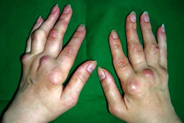 Hands with polyarthrosis deformans
