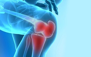 how osteoarthritis of the knee joint manifests