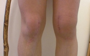 stages of development of osteoarthritis of the knee