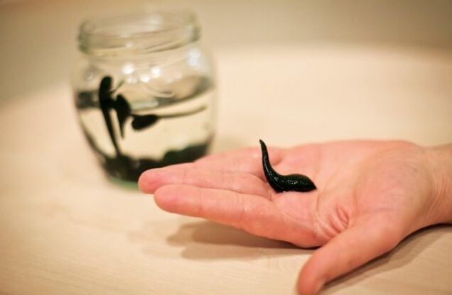 Therapeutic leeches for osteoarthritis of the knee joints can reduce swelling, relieve inflammation and anesthetize